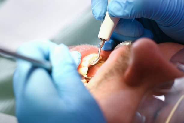 Emergency Dental Filling Replacement in SD